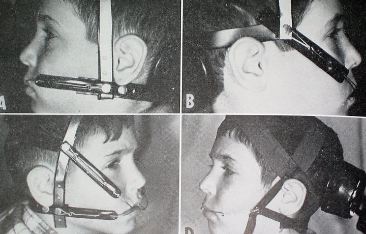 história do aparelho dentário
